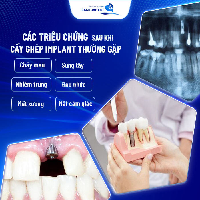 8 Lưu Ý Chăm Sóc Sau Cấy Ghép Implant Đúng Cách 8 Chăm Sóc Sau Cấy Ghép Implant Đúng Cách
