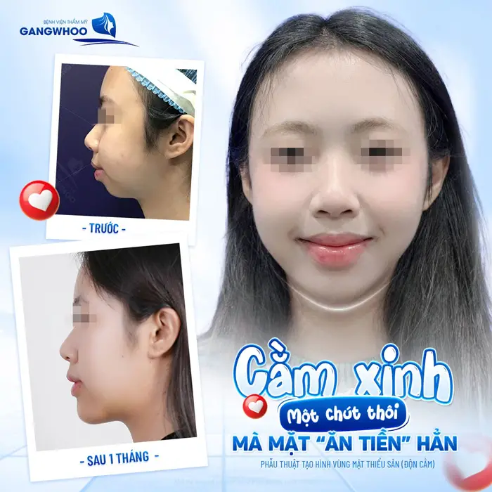 Cằm xinh thon gọn, sau 1 tháng đã tự tin với góc nghiêng đẹp thanh thoát và mềm mại