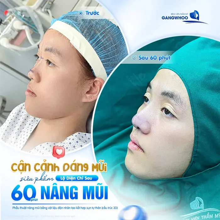 Cận cảnh dáng mũi sieue phẩm lộ diện chỉ sau 60 phút can thiệp 