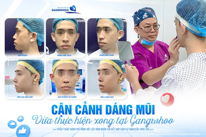 Cận cảnh dáng mũi vừa thực hiện xong tại Gangwhoo góc nghiêng đẹp lên thấy rõ