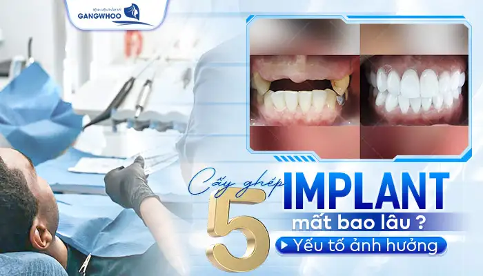 Cấy Ghép Implant Mất Bao Lâu? 5 Yếu Tố Ảnh Hưởng 9 Cấy Ghép Implant Mất Bao Lâu