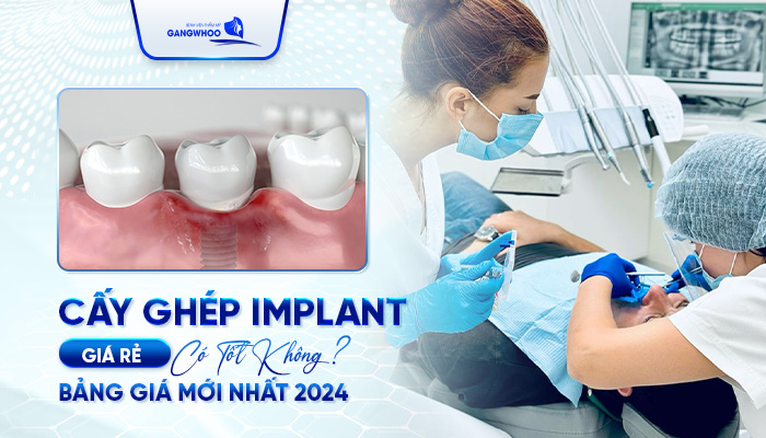 Cấy Ghép Implant Giá Rẻ