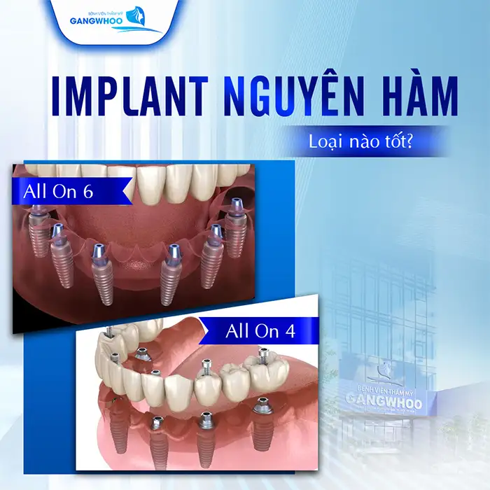 cay ghep implant nguyen ham loai nao