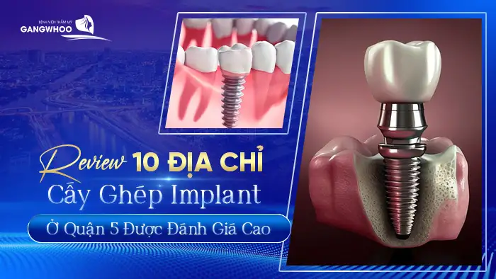 cay ghep implant tai quan 5