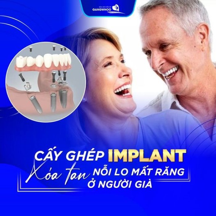 Top 6 Địa Chỉ Cấy Ghép Implant Tốt Nhất Bến Tre Mà Bạn Có Thể An Tâm Đến Thực Hiện