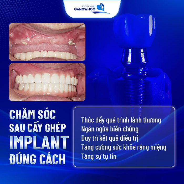 8 Lưu Ý Chăm Sóc Sau Cấy Ghép Implant Đúng Cách 9 Chăm Sóc Sau Cấy Ghép Implant Đúng Cách