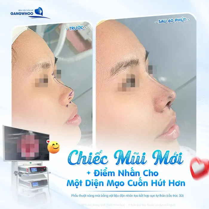 Chiếc mũi mới điểm nhấn cho 1 diện mạo thêm cuốn hút và ấn tượng sau 60 phút đã hoàn toàn khác biệt