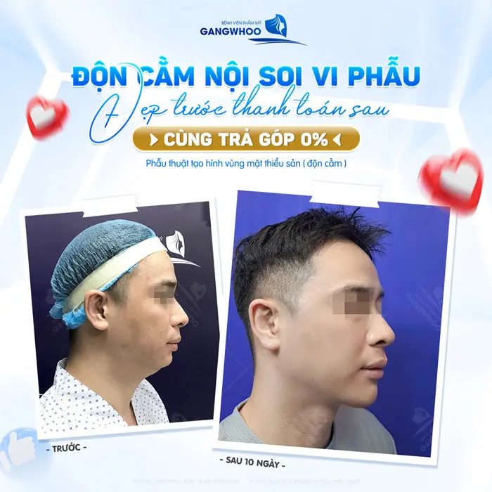 Độn cằm nội soi vi phẫu đẹp trước thanh toán sau với chi phí trả góp 0%