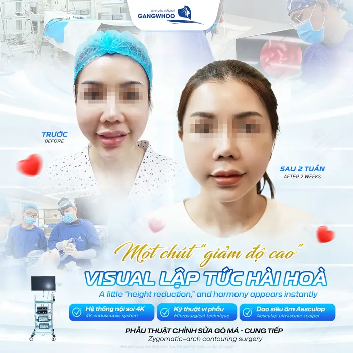 Phẫu thuật chỉnh sửa gò má - cung tiếp giảm độ cao gò má mặt hài hòa, cân đối hơn