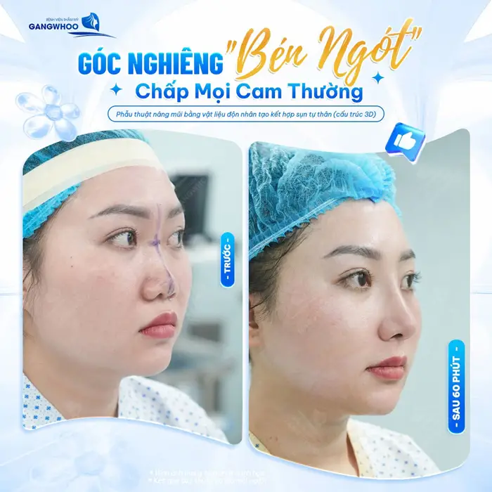 Góc nghiêng sống mũi cao đẹp bất chấp cam thường sau nâng sống mũi dựng trụ tại Gangwhoo