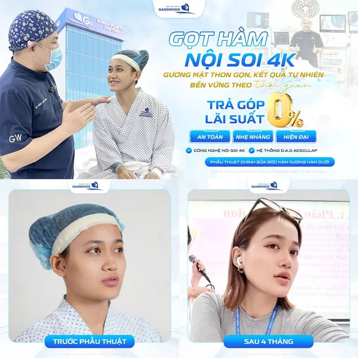 Gọt hàm nội soi 4K gương mặt thon gọn, kết quả đẹp tự nhiên đẹp bền vững theo thời gian với lãi suất 0%