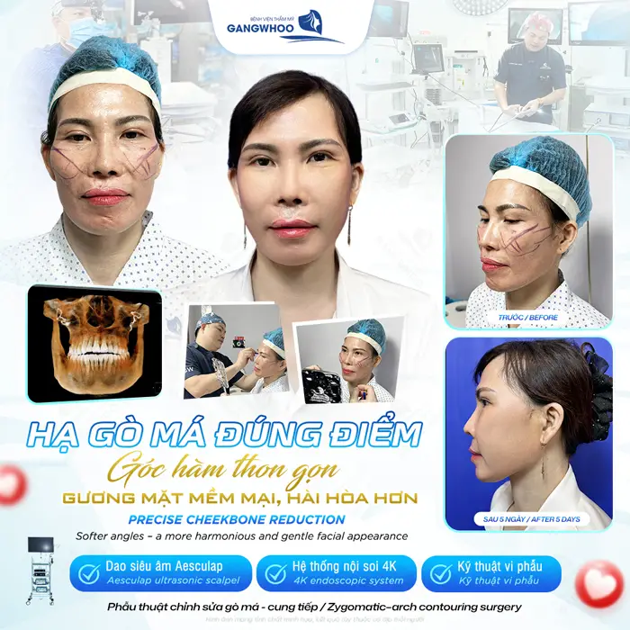 Hạ gò má đúng điểm góc hàm thon gọn gương mặt mềm mại, hài hòa và thon đẹp hơn trước rất nhiều 
