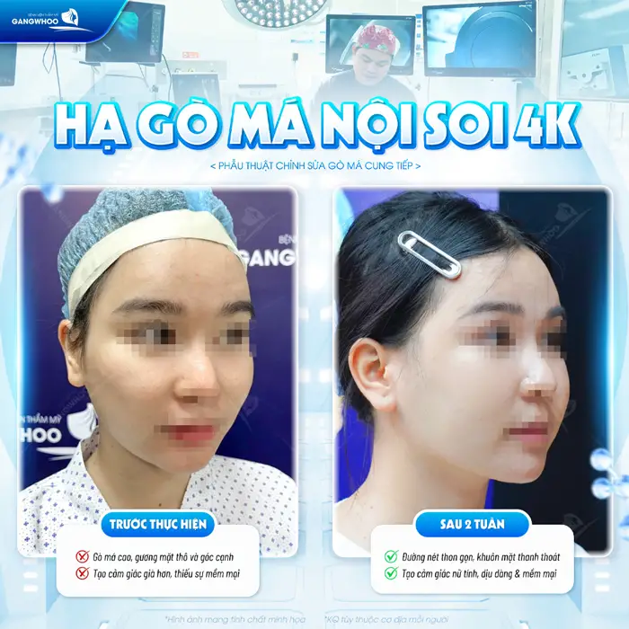 Hạ gò má ứng dụng công nghệ nội soi 4K đường nét thanh thoát nét mặt hài hòa và cân đối đẹp thon gọn 