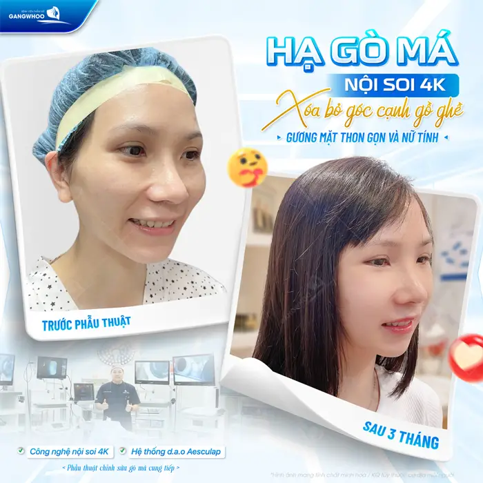 Hạ gò má nopiọ soi 4K xóa bỏ góc cạnh gồ gương mặt thêm nữ tính và thanh thoát hơn sau thực hiện