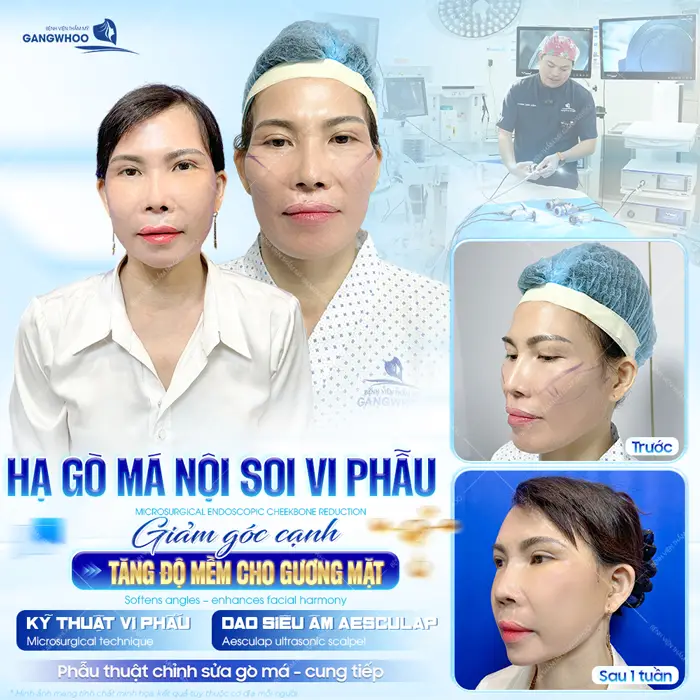 Phẫu thuật chỉnh sửa gò má - cung tiếp giảm góc cạnh tăng độ mềm cho diện mạo gương mặt