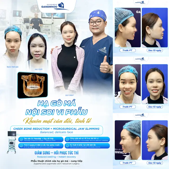 Phẫu thuật chỉnh sửa hạ gò má - cung tiếp khuôn mặt cân đối đẹp đầy tinh tế
