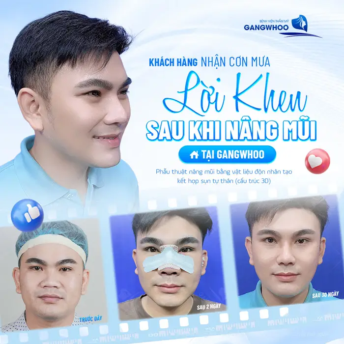 Nâng Mũi Cấu Trúc Surgiform Và Những Điều Cần Biết 1 Sau phẫu thuật nâng mũi tại Gangwhoo nhận cơn mưa lời khen vì dáng mũi quá đẹp quá hài hòa