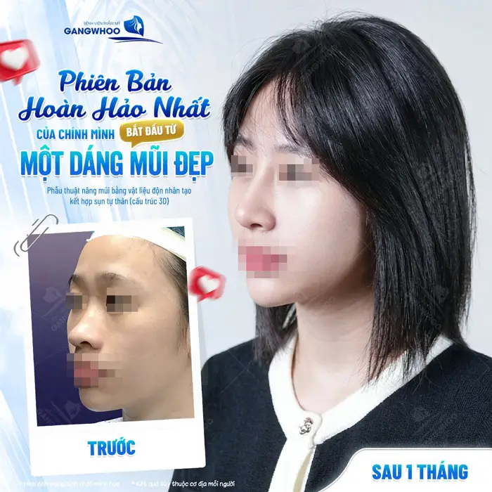 Phiên bản hoàn hảo nhất bắt đầu với 1 dáng mũi đẹp sau 1 tháng diện mạo đã hoàn toàn khác biệt