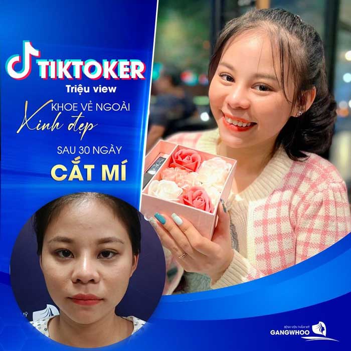 Chia Sẻ Hành Trình Cắt Mí Mắt Của TikToker Phan Yến Nhi Tại BVTM Gangwhoo 32 Nếp mí sau 1 tháng thực hiện tại BVTM Gangwhoo