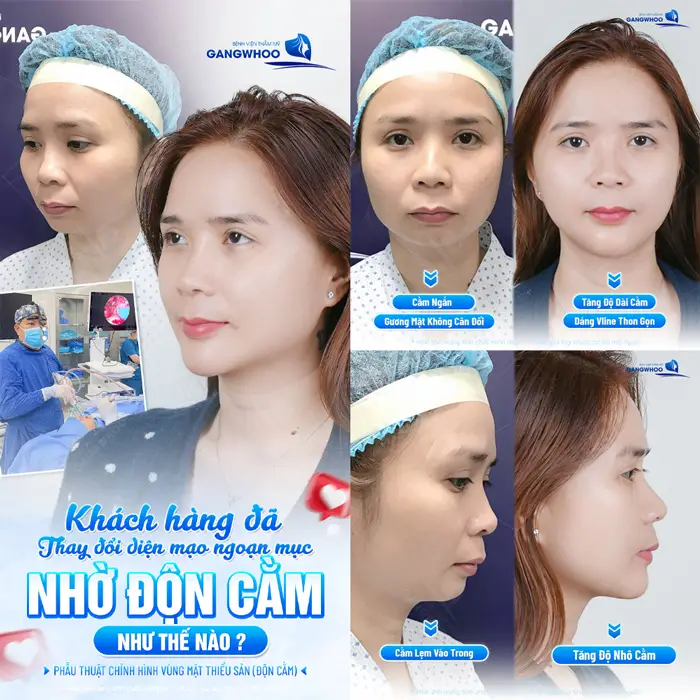Khách hàng độn cằm tại bệnh viện thẩm mỹ Gangwhoo diện mạo thay đổi ngoạn mục nhan sắc thăng hạng và đẹp tự tin 