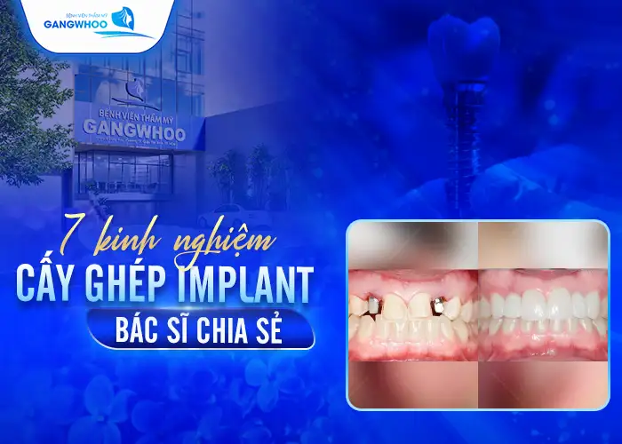 Kinh Nghiệm Cấy Ghép Implant