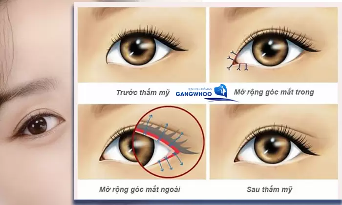 mo goc mat mat khac phuc tinh trang mat xech 1 cach hieu qua