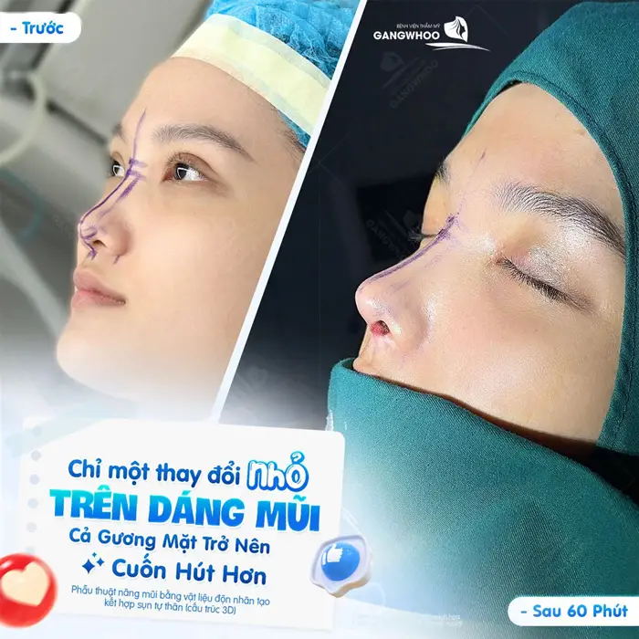 Chỉ 1 thay đổi nhỏ ở dáng mũi gương mặt đã trở nên cuốn hút và có hồn hơn 