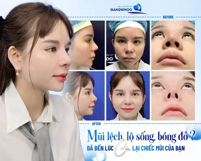 Sửa Mũi Hỏng Phương Pháp Khắc Phục Biến Chứng Sau Nâng Mũi 7 Mũi lệch sụn, lộ sống là 1 dấu hiệu nâng mũi bị hỏng và cần phải khắc phục lại sớm