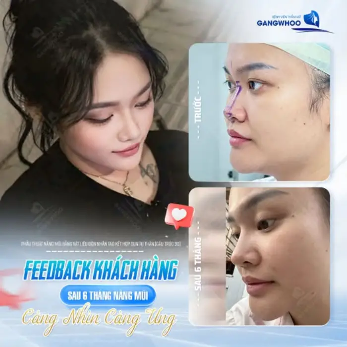 Dáng mũi 'bay' tinh tế sau 6 tháng thẩm mỹ – Gương mặt trẻ trung, thần thái hơn nhờ kỹ thuật nâng mũi chuyên sâu tại Gangwhoo