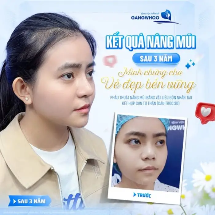 Kết quả nâng mũi cấu trúc 3D đẹp chuẩn được nhiều khách hàng yêu thích