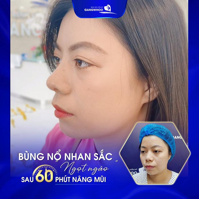 Nâng Mũi Cấu Trúc Surgiform Và Những Điều Cần Biết 3 nang mui cau truc 4