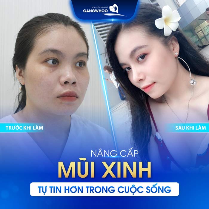 Nâng Mũi Cấu Trúc Kín Là Gì? Nên Nâng Mũi Mổ Kín Hay Mổ Hở? 7 Nâng Mũi Cấu Trúc Kín Là Gì