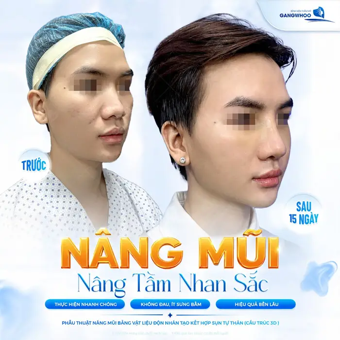Nâng mũi nâng tầm nhan sắc diện mạo đẹp hơn thấy rõ sau 15 ngày tái khám