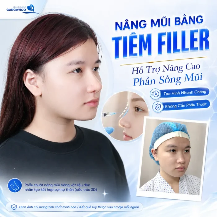 Nên Nâng Mũi Bằng Chỉ Hay Tiêm Filler? Bác Sĩ Giải Đáp 1 Nên Nâng Mũi Bằng Chỉ Hay Tiêm Filler? Bác Sĩ Giải Đáp
