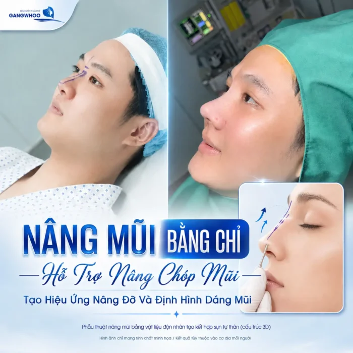 Nên Nâng Mũi Bằng Chỉ Hay Tiêm Filler? Bác Sĩ Giải Đáp 2 Nên Nâng Mũi Bằng Chỉ Hay Tiêm Filler? Bác Sĩ Giải Đáp