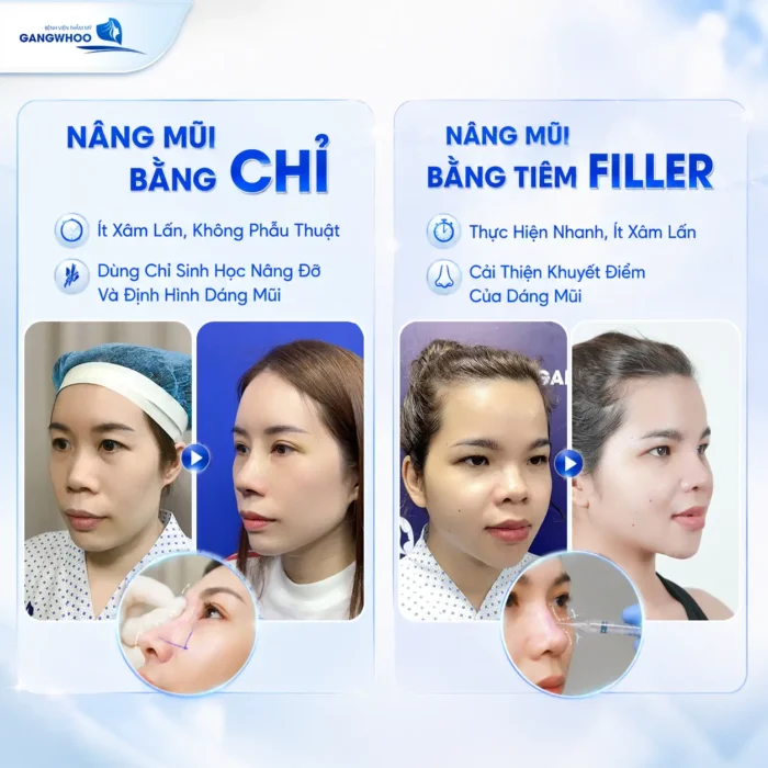 Nên Nâng Mũi Bằng Chỉ Hay Tiêm Filler? Bác Sĩ Giải Đáp 3 Nên Nâng Mũi Bằng Chỉ Hay Tiêm Filler? Bác Sĩ Giải Đáp
