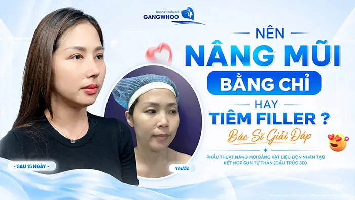 nen nang mui bang chi hay tiem filler