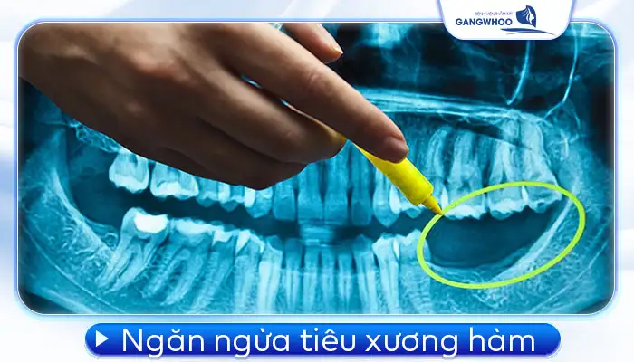 Các Trường Hợp Nên Cấy Ghép Implant Bác Sĩ Chỉ Định 2 Các Trường Hợp Nên Cấy Ghép Implant