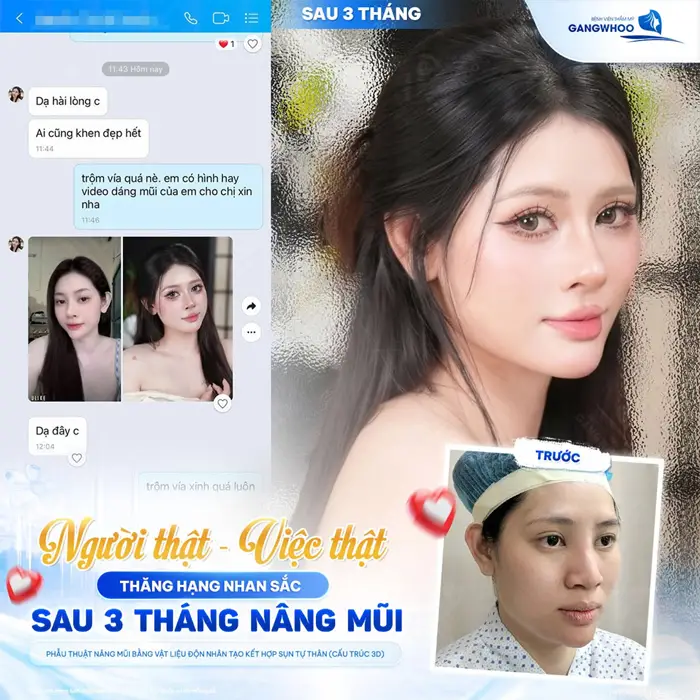 Dáng mũi đẹp chuẩn thăng hạng nhan sắc đẹp chấn đông sau 3 tháng nâng mũi tại Gangwhoo