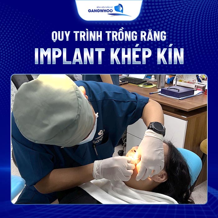 Cấy Ghép Implant Nguyên Hàm