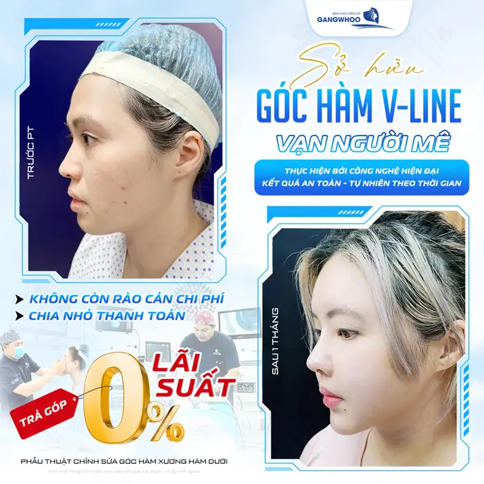 Sở hữu góc hàm V Line đẹp vạn người mê thực hiện bởi công nghệ hiện đại không còn lo áp lực chi phí 