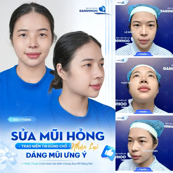 Nâng Mũi Cấu Trúc Có Bị Tụt Sụn Không? Nguyên Nhân, Cách Khắc Phục 5 Sửa mũi hỏng treo niền tin đúng chỗ khắc phục lại khuyết điểm cho dáng mũi cao đẹp như ý