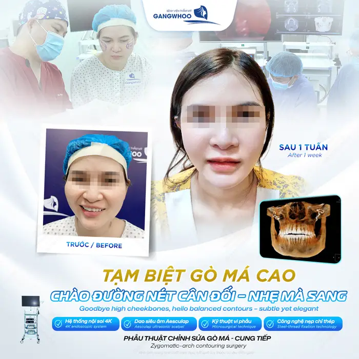 Tạm biệt gò má cao chào đường nét cân đối cao sang với kỹ thuật phẫu thuật chỉnh sửa gò má - cung tiếp