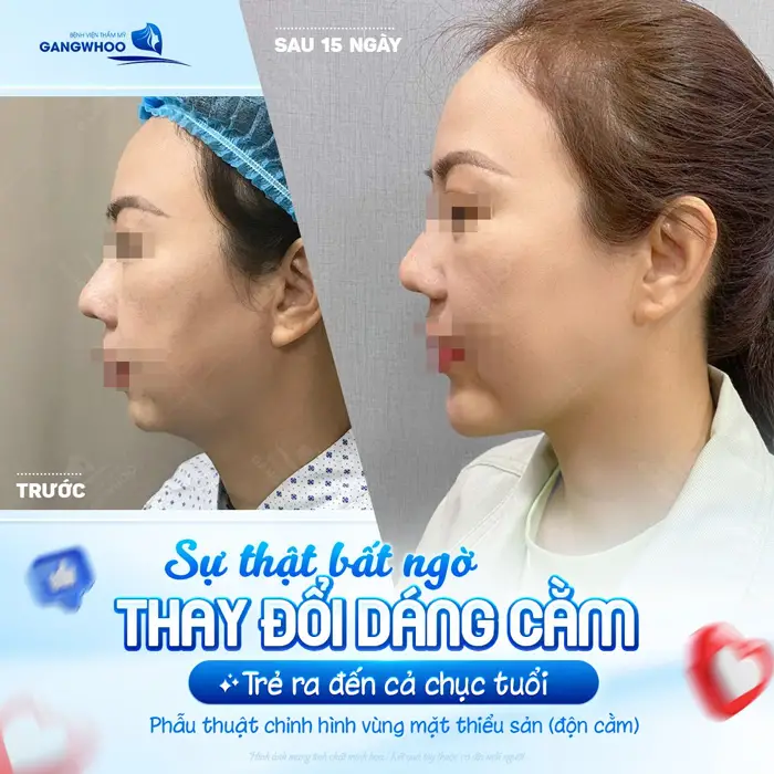 Thay đổi dáng cằm trẻ ra đến chục tuổi chỉ sau 15 ngày đã hoàn toàn khác biệt đến khó tin