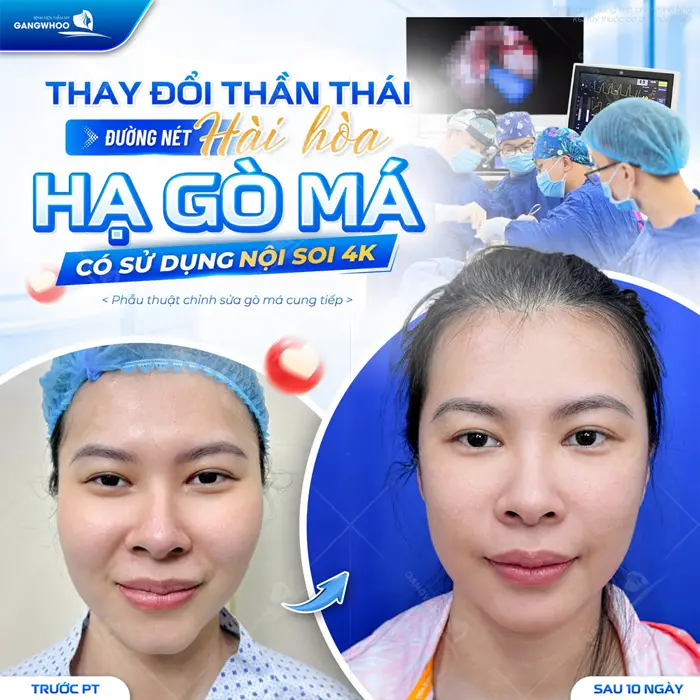 Thay đổi thần thái đường nét hài hòa cho gương mặt thêm cân đối chỉ sau 10 ngày đã hoàn toàn khác biệt