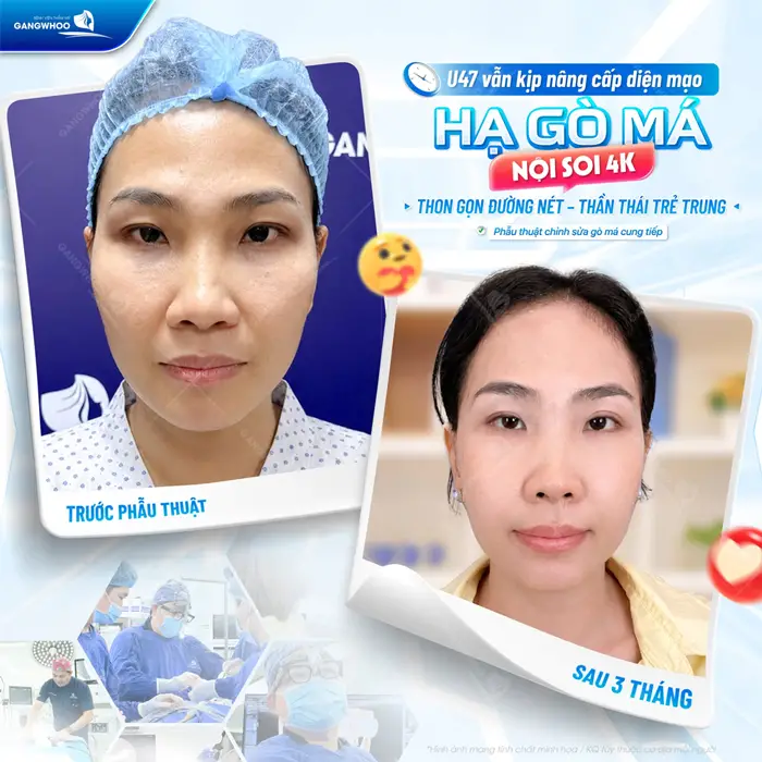 U47 vẫn kịp nâng cấp diện mạo với hạ gò má nội soi 4K đường nét thêm thon gọn và thần thái thêm trẻ trung