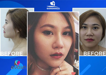 vline jaw surgery bao chi