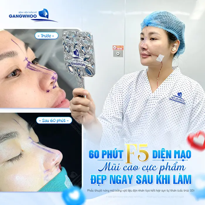 60 phút F5 diện mạo mũi cao cực phẩm đẹp ngay sau khi làm tôn lên diện mạo bừng sáng 