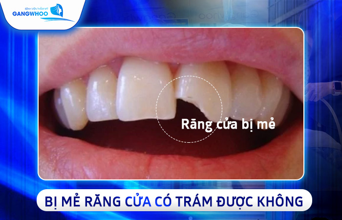 Trám Răng Mẻ 
