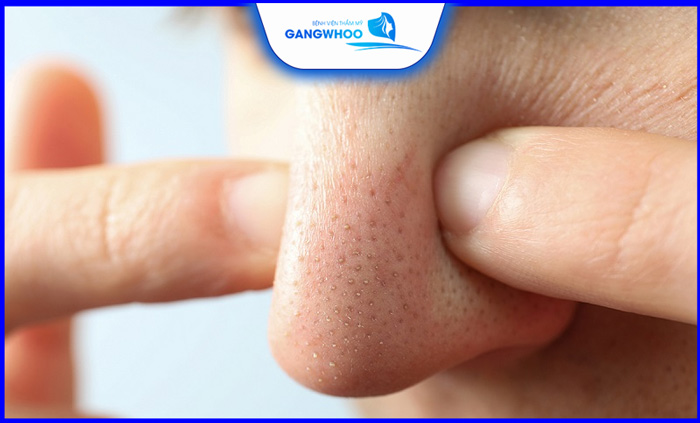 Cách Trị Mụn Đầu Đen Ở Mũi